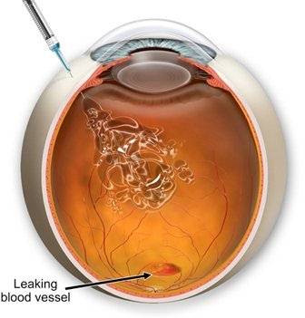 pcnotchtree's tweet photo. Dropped #Visionace & 4mg Lutein, now on #MacuLEH, 3 x 10mg lutein a day. Back 2 Aug for next Eylea injection. #macular @SunderlandEye https://t.co/43NU7uOwHA