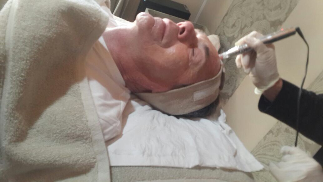 goddess_factor's tweet photo. Phase Two: 100's of tiny needle pricks #microneeding Pen @Tonyblewitt Cool as a Cucumber. Needling the Skin boosting collagen production! https://t.co/42uDjUIzRN