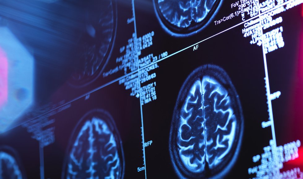 Lifestyle changes may help stave off #Alzheimer's:   bit.ly/2uLSzV3 https://t.co/1mRs26rQE1