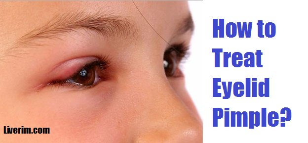 Liverimdotcom's tweet photo. How to Get Relief from Eyelid #Pimple?
https://t.co/AJ9r4izjin
#acne #eyecare #eye #homeremedies #natural #cure #beauty #health #homeremedy https://t.co/DexSw38RpE