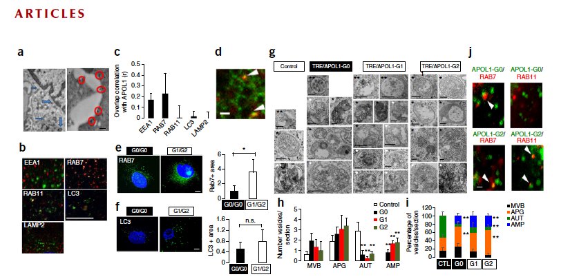KSusztak's tweet photo. Part3 Endocytic trafficking defect In patient cells https://t.co/gRoDntQDpg https://t.co/Cmd2tRmcsY