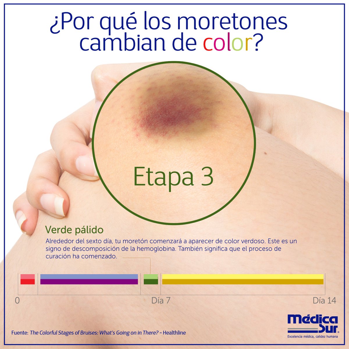 medicasur's tweet photo. ¿Por qué los #moretones cambian y cuánto duran? Te explicamos cada etapa. #MédicaSur #DatosCuriosos #Ciencia #CuerpoHumano #Hematomas https://t.co/Fk8Kgp1G2o