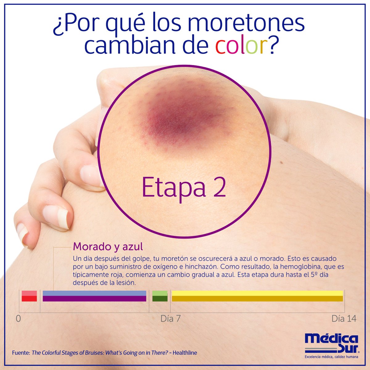 medicasur's tweet photo. ¿Por qué los #moretones cambian y cuánto duran? Te explicamos cada etapa. #MédicaSur #DatosCuriosos #Ciencia #CuerpoHumano #Hematomas https://t.co/Fk8Kgp1G2o