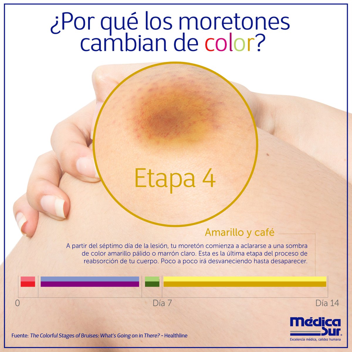medicasur's tweet photo. ¿Por qué los #moretones cambian y cuánto duran? Te explicamos cada etapa. #MédicaSur #DatosCuriosos #Ciencia #CuerpoHumano #Hematomas https://t.co/Fk8Kgp1G2o