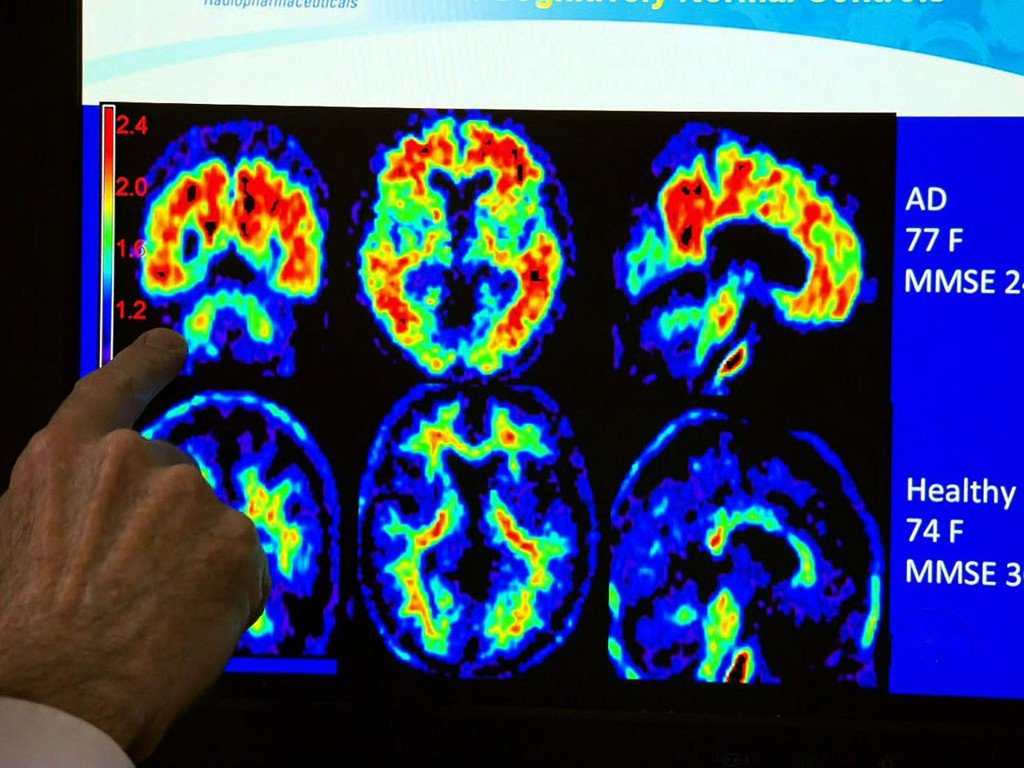 CBSNews's tweet image. One-third of dementia cases could be prevented, report says cbsn.ws/2uOtzMQ