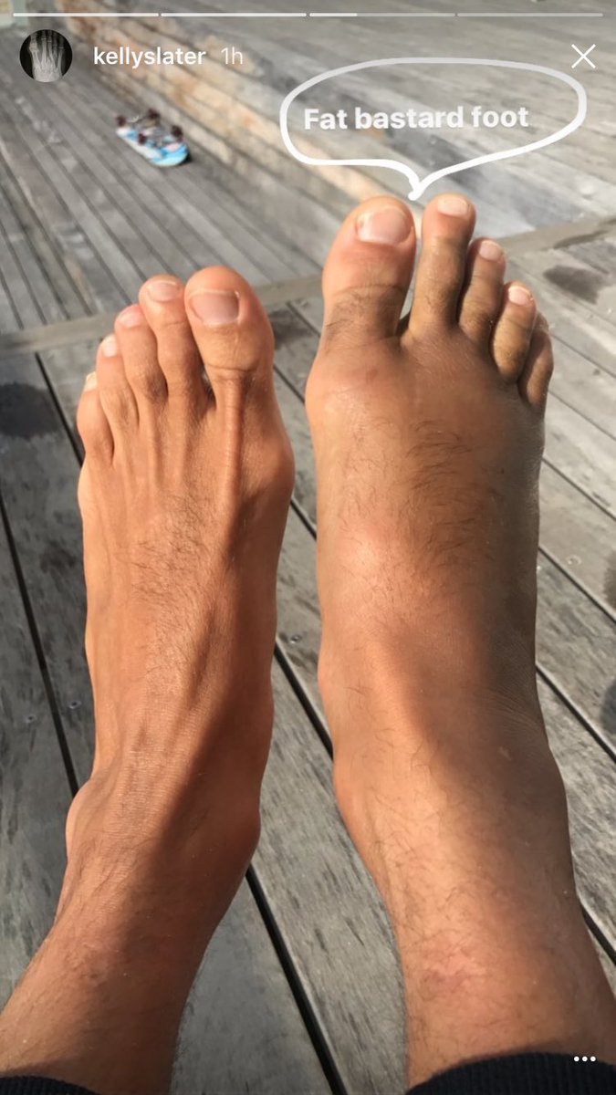 Surfsessionmag Impressionnante Photo Du Pied Casse De Kellyslater Via Son Compte Instagram Surfsessionmag Impressionnante Photo Du Pied Casse De Kellyslater Via Son Compte Instagram
