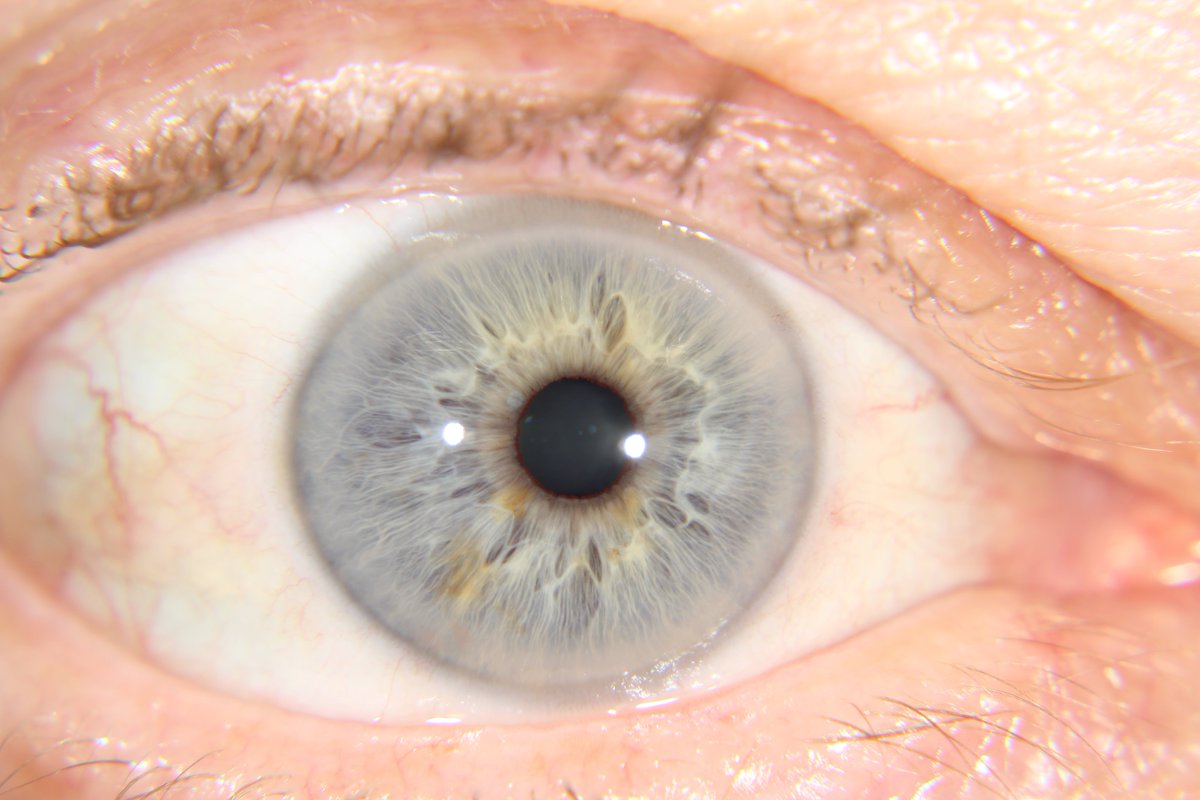 IrisSupplies's tweet photo. Taken with the eyePIX Handheld. Contact Mark at iriscope@bigpond.net.au to find out more #Iridology #Iridologist #Iriscope #Iridologists https://t.co/iave2gQe4K