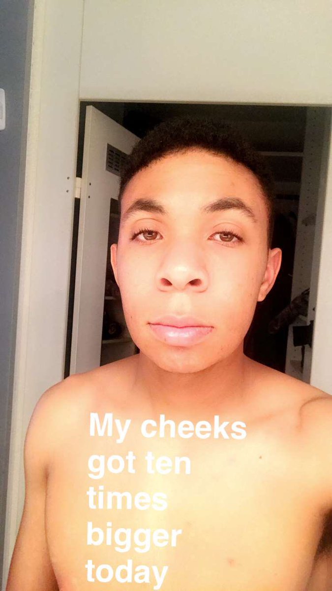 ShawnTite's tweet photo. Who's gonna love me now? #wisdomteeth #swollencheeks #sad https://t.co/W9zhqlZs7D