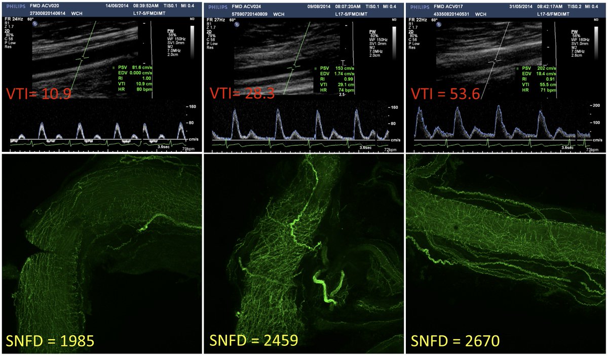 MathiasBaumert's tweet photo. Elegant study on vascular structure &amp; function in children with #SleepApnea 
@kontos_anna @RobsInstitute 
https://t.co/fuLkBK7QAE https://t.co/zEMDVgAmJT