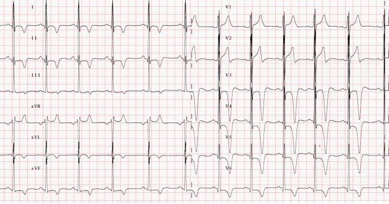 #ECGofTheWeek final diagnosis: Fabry's disease. Full details on our FB page bit.ly/2gPdWP4 #ECG #ECGchat #ESCCoT