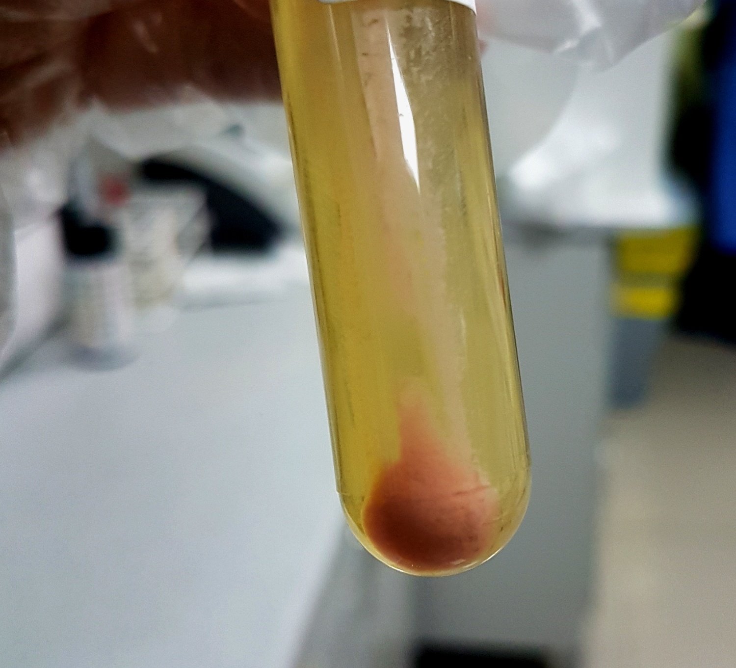 amorphous urates in urine