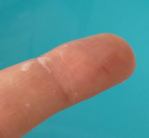 J+12 après ma greffe de cheveux FUE : quelques cheveux greffés tombent mais rien d'anormal bien-etre-sante.info/12-jours-apres…