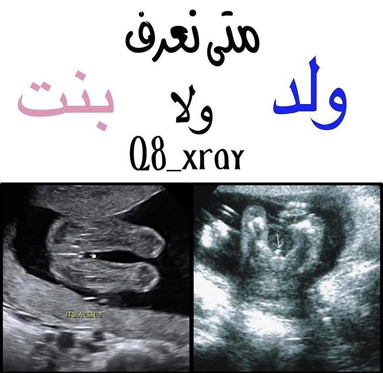 Council Sur Twitter Radiologist أفضل موعد لمعرفة جنس الجنين هو في الشهر الخامس ، حيث تصل دقة السونار إلى أكثر من 90 ، ولا يفضل إجراؤه قبل ذلك Https T Co Uuqd8iyizd