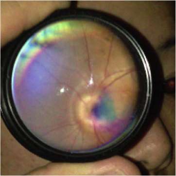veranahealth's tweet photo. It's #FundusFriday again! Which of you can guess the #pathology in this picture? #Paxos #eyecare #telemedicine #mhealth #retinalimage https://t.co/HCdhJkCdNv