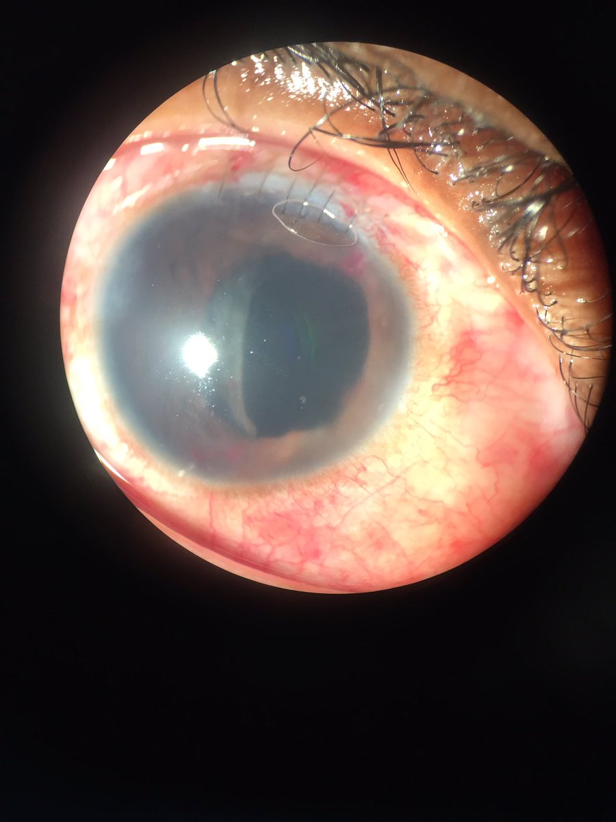 vitreo_retina's tweet photo. Pctes #complicaciones #operatorias #manejo #complicaciones #resultados #cirugia #Catarata #vitreo #retina #resultados #BuenaVisión #eyecare https://t.co/UwS6zNEioB