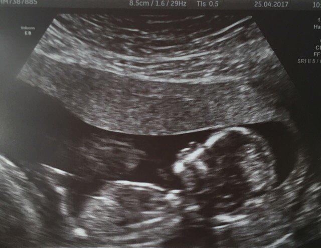loueezecee's tweet photo. I think I can safely share this with you all now. My niece Laura, is expecting her first baby in Oct. 😍 #NappyDays https://t.co/mtqHscI1sQ