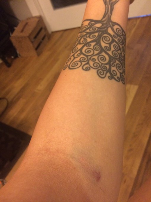 I always bruise ;) haha play safely and know your status! #tts #talenttest #gettested #knowyourstatus<a href="/tag/knowyourstatus"class="tags"><span>#knowyourstatus</span></a><a href="/tag/gettested"class="tags"><span>#gettested</span></a><a href="/tag/tts"class="tags"><span>#tts</span></a><a href="/tag/talenttest"class="tags"><span>#talenttest</span></a>