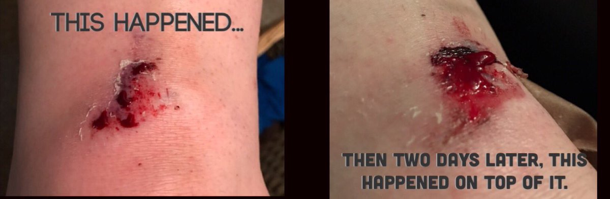 ScareTastic's tweet photo. MY FUCKING KNEE IS GROUND BEEF &amp; HURTS!!!!!! https://t.co/hcZXCqsJwt