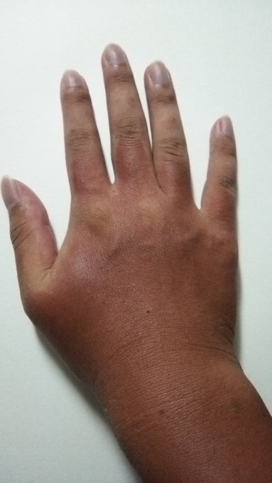 すっげぇ赤くなってる、はっきりわかんだね(日焼け) 