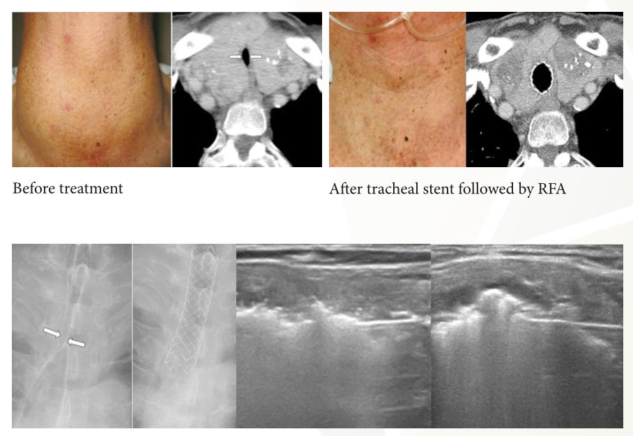 DrThyroid's tweet photo. Thyroid RFA 101:Large goiter,airway treated with temporary tracheal stenting &amp; Radiofrequency ablation. https://t.co/SZfYbSnF47 https://t.co/KU6UYoj075