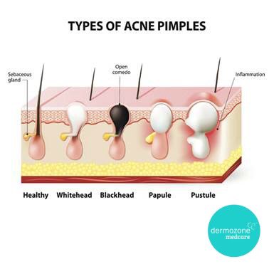dermozone's tweet photo. Identifying which type of acne you’re experiencing is key to successful treatment. Acne may be noninflammatory or inflammatory. - https://t.co/ZyhTYcX9kh