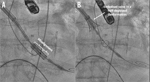 EuroInterventio's tweet photo. How should I treat an Edwards SAPIEN 3 aortic valve embolisation during a #TAVI ? https://t.co/6HTuq9vwFT @EdwardsLifesci @FournierS87 https://t.co/BjesYIcClS