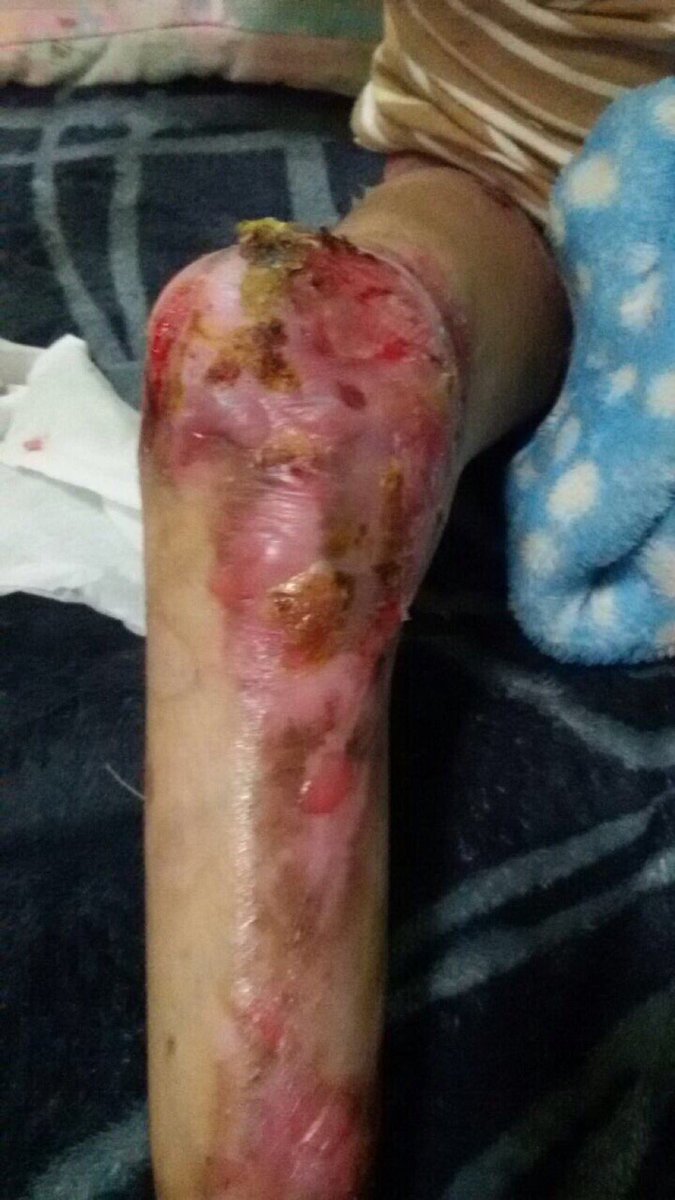 #لاتقف عندك 
إلى وزارةالصحة 
في المملكة العربيةالسعودية
#الطفل_حاتم_العتيبي من سكان #الرياض
يبحث عن علاج 
همتكم بإيصال صوته
والده ٠٥٥٢٤٧٤١٢٥