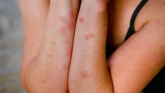 ankapestcontrol's tweet image. Hangi Böcek Isırıyor, Ne Yapmalıyım? tinyurl.com/ybmtpchb