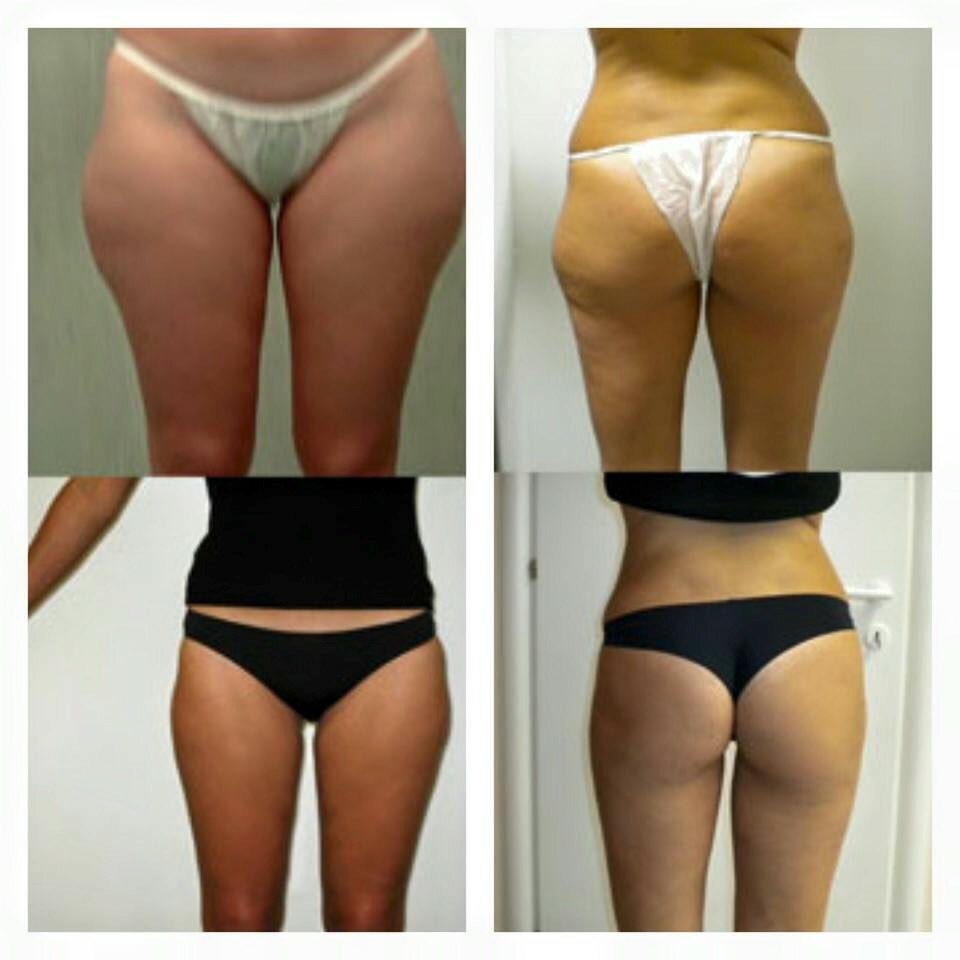 Tizianalifesty1's tweet photo. ↘Via la cellulite 
↘Pelle più compatta
↘Corpo più tonico
Scrivi ok e ti spiegherò come fare 😉#perdipeso #dieta #pesoforma #addiocellulite https://t.co/ex366TipHP