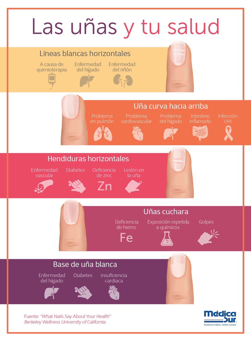 almagoch's tweet photo. La uñas como reflejo de enfermedades sistémicas ... solo con ver una onicomicosis blanca próximal, se puede pensar en #HIV https://t.co/yO1zRJCv58