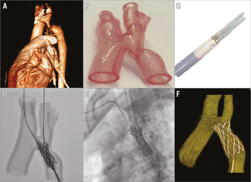 EuroInterventio's tweet photo. Stenting complex aortic coarctation: simulation in a 3D printed model https://t.co/hyegzDGT31 https://t.co/3WrXM509sl