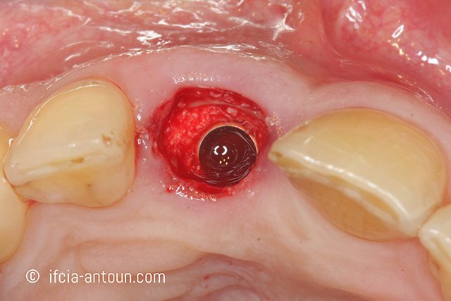 drhadiantoun's tweet photo. Mise en place d'implant après extraction dentaire : données cliniques par différentes approches. #socketshield #implantologie #impantology https://t.co/cY5NTAsUhE