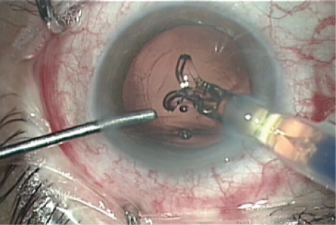 CRST_global's tweet photo. Read these considerations for implanting #PremiumIOLs in patients with previous #RefractiveSurgery: https://t.co/ZBtPl1eoyv https://t.co/JpC8jnajBy