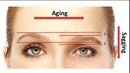 ClinicSloane's tweet photo. How To Lift #Eyebrows With #Cosmetic #Surgery  :-
https://t.co/7VzlqfYoQT https://t.co/BXpmePCt42