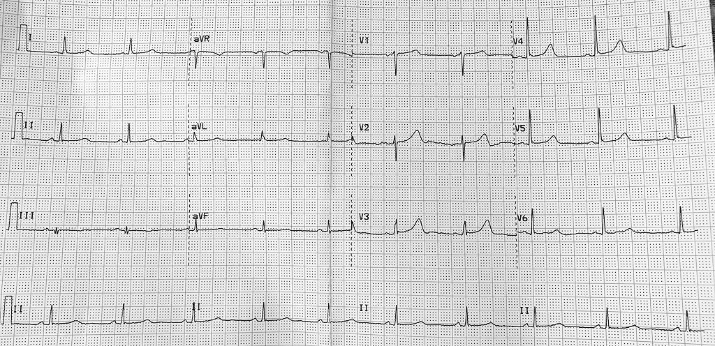 60 y/o female w/ T2DM, intermittent CP x1 week at pcp . Hyperacute Ts or have I been watching too much <a href="/amalmattu/">Amal Mattu</a>? <a href="/EM_RESUS/">Sam Ghali, M.D.</a> <a href="/embasic/">Steve Carroll DO MEd</a>