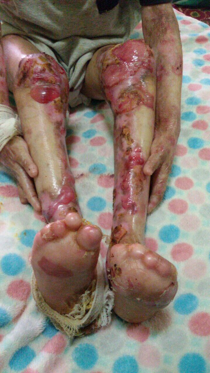 أقسم بالله أن بعض الحالات تتعبني
ولكن لابد من نشرها
ماذا أفعل تتصل عليك أم يتقطع قلبها
وهي تشاهد طفلها يتعذب يوميا أمامها
من الألم
يارب لطفك