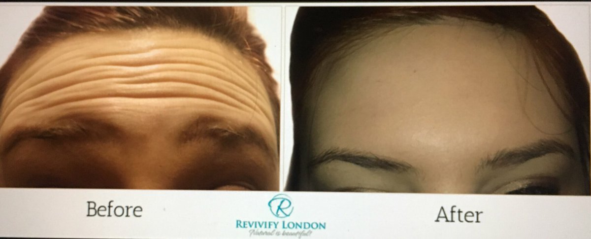 RevivifyLondon's tweet photo. Want to be a model in our training day for wrinkle reduction injection today? PM us. #model #antiageing #beauty #botox #botoxcourse https://t.co/J3jGgQbhdU