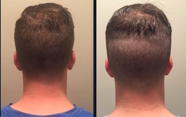jasonraser5's tweet photo. check out my before/after only 5 days after #neograft procedure (donor site) #prettyincredible #newesttechnology #clinicalsatisfaction #FUE https://t.co/vzqUONXcBC