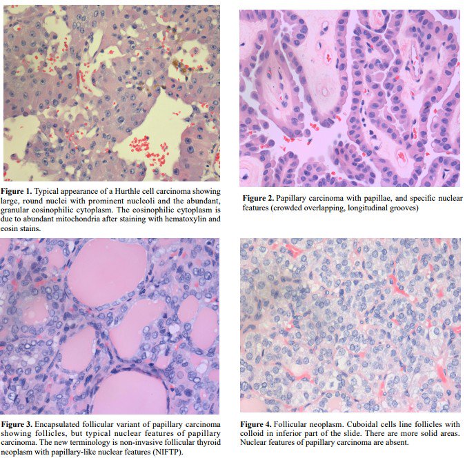 AMOR_PiscoMed's tweet photo. #OnlineFirst: Overview of Hurthle cell carcinoma of thyroid by Korzeniowski, et al.
https://t.co/Y3fTksX8Ol https://t.co/LKLCWJq25C