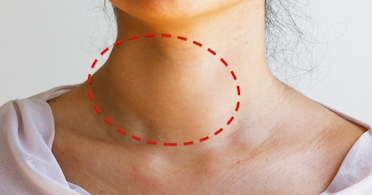 tuasaude's tweet photo. 5 problemas que causam caroço no pescoço - saiba o que pode ser! https://t.co/MrVGDxmFBe #nodulo-na-tireoide #pescoco #endocrinologista https://t.co/m5XqHdb0i2