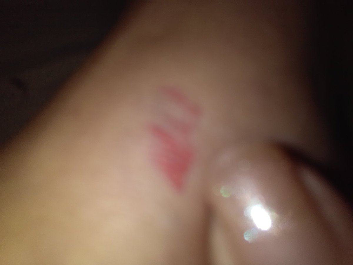 stargazerufo's tweet photo. Visitation the last 3 nights heres the remnants they left me looks like skin scrape other is swollen top foot worse is pinchd nerves still https://t.co/mnAay8F7h1