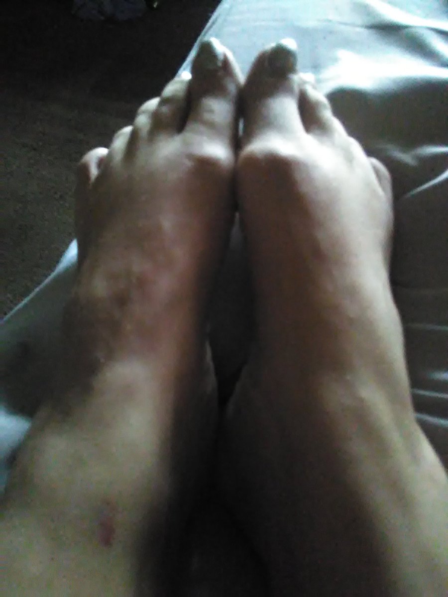 Visitation the last 3 nights heres the remnants they left me looks like skin scrape other is swollen top foot worse is pinchd nerves still