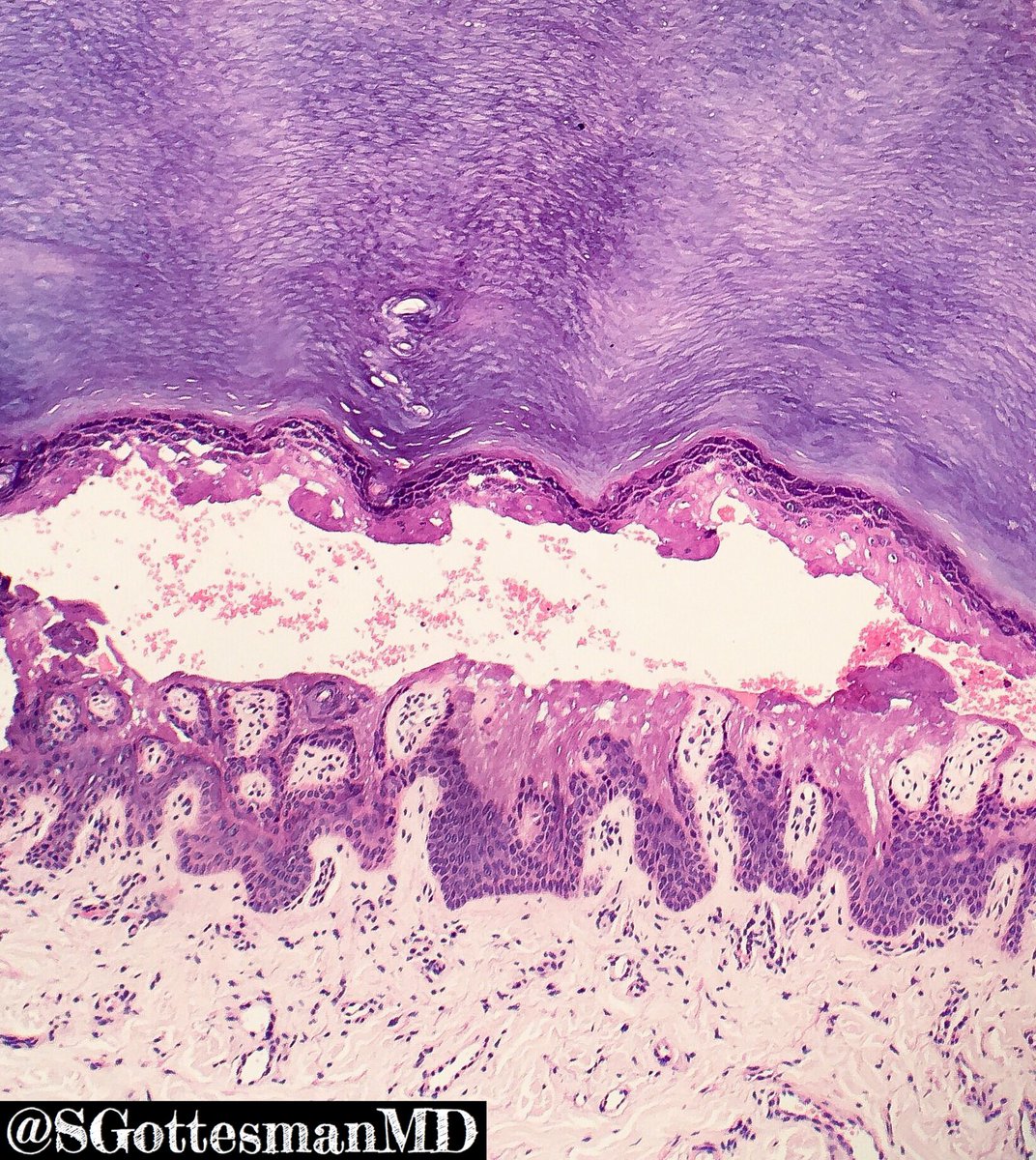 She got a new pair of shoes 💁🏻👠 &amp; then this happened. Friction blister. Subgranular blister with epidermal necrosis, sparse lymphs #dermpath