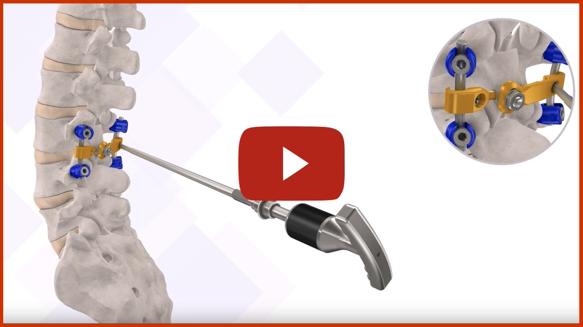 vtispine's tweet photo. An American Made Pedicle Screw System! https://t.co/e1KSXNa8L8 #pediclescrew #spinefusion #spine #fusionsurgery https://t.co/PEjUhzmCtn