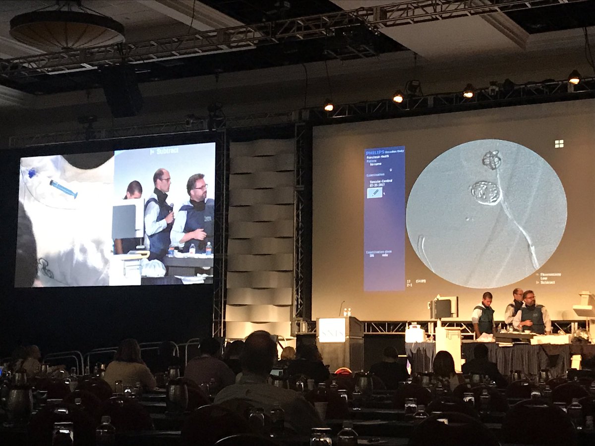 Shoirahz's tweet photo. @JMoccoMD demonstrating the use of a #Pulserider to reconstruct the neck of an otherwise uncoilable basilar tip #aneurysm at #SNIS2017 https://t.co/bJ5qUjMfvF