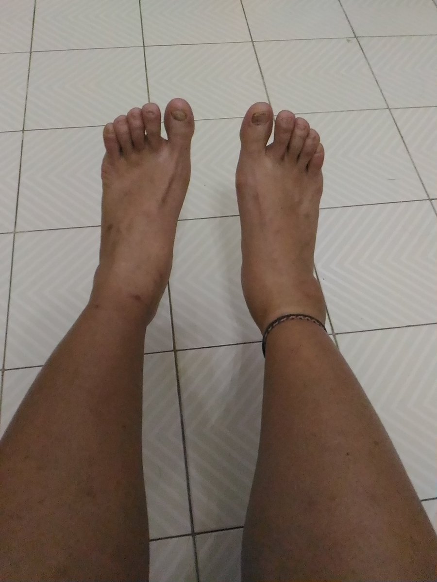 maslight's tweet image. #RunnersProblem when u twisted ur ankle and wondering when u can be back on track 😂😂😂