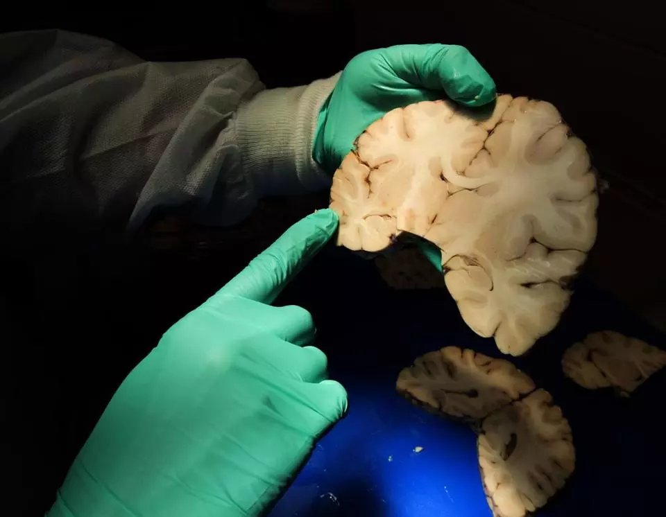 BostonGlobe's tweet photo. A Boston study found many deceased football players suffered a brain disease linked to repeated head injuries. https://t.co/xyFM3DdW5j https://t.co/92KdWZt2an