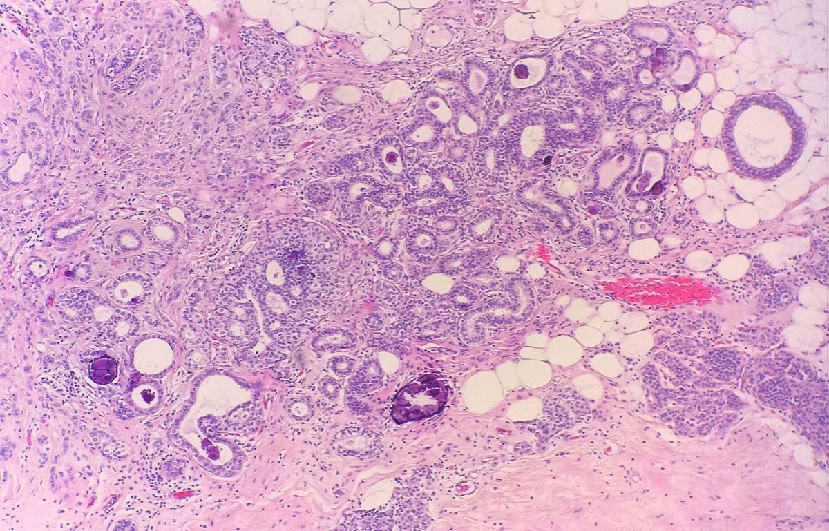 dr_MPrieto's tweet photo. #caseoftheday incidental finding of a 3 mm lesion with a full spectrum of breast pathology!! HE &amp; E-cadherin #brstpath #pathology https://t.co/52DrZBFoAN
