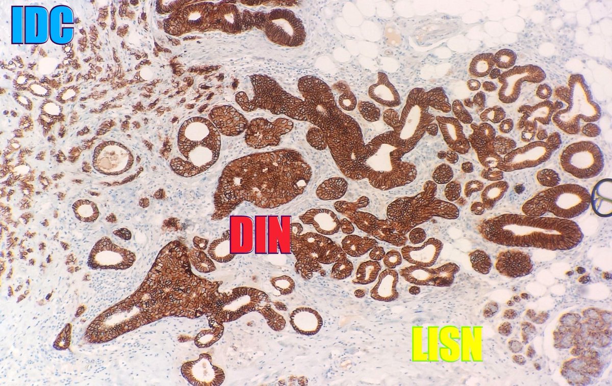 dr_MPrieto's tweet photo. #caseoftheday incidental finding of a 3 mm lesion with a full spectrum of breast pathology!! HE &amp; E-cadherin #brstpath #pathology https://t.co/52DrZBFoAN