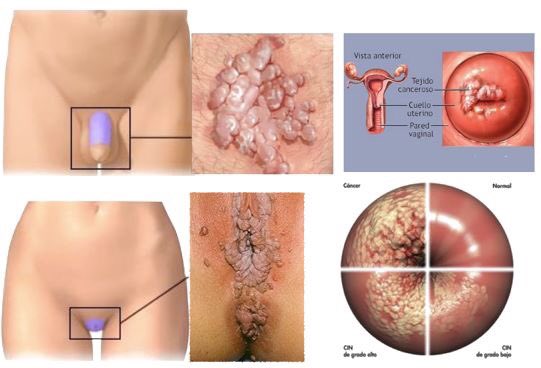 VACUNA VPH

¿Para quién es aconsejable la vacuna?
¿Cómo se transmite?
¿Cómo se detecta?

clinicabau.com
#ClínicaBAU #CórdobaEsp